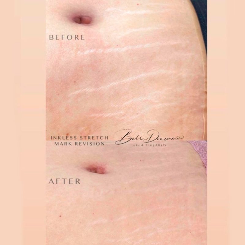 Inkless-stretch-mark