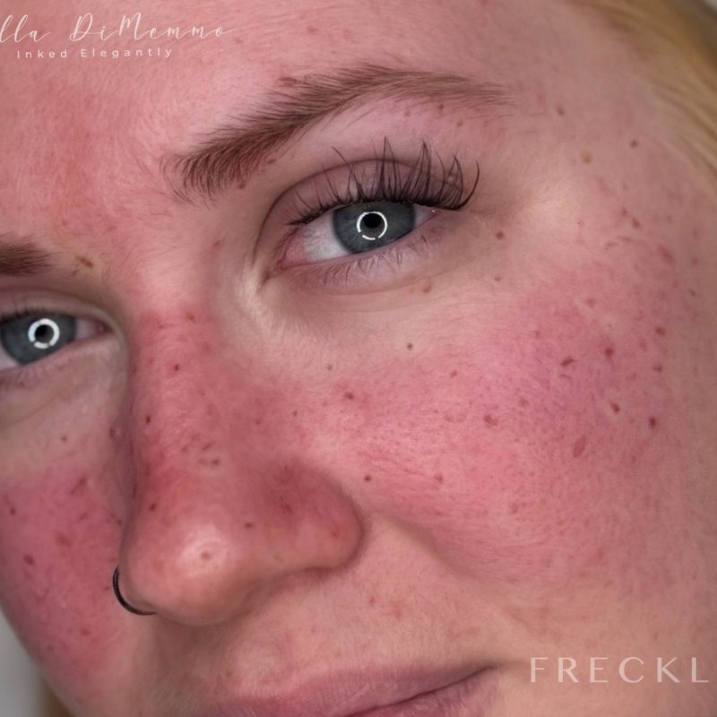 freckles