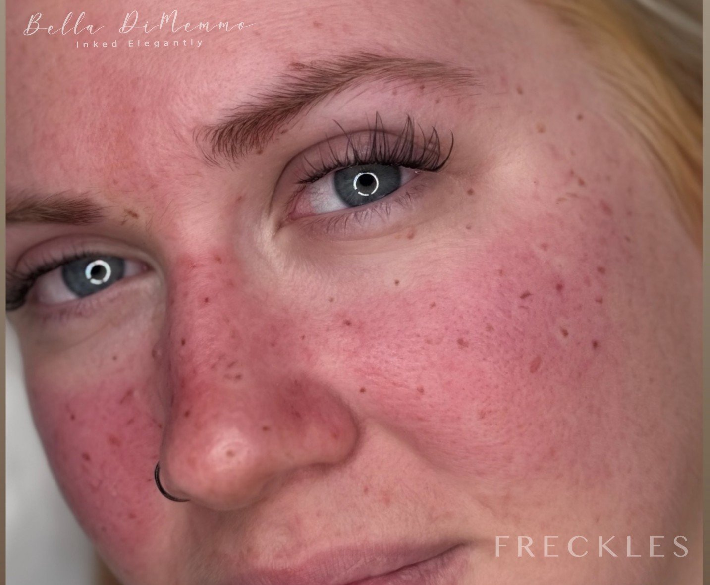freckles
